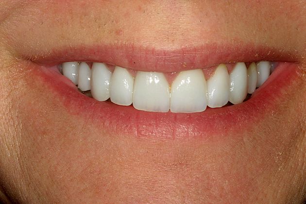 Veneers Case 7 - After