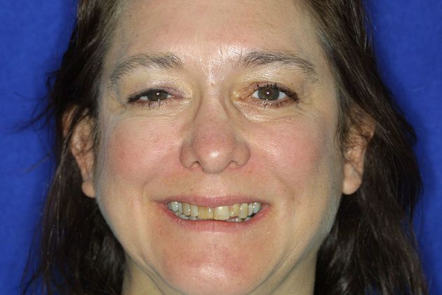 Veneers: Case 7 - Before