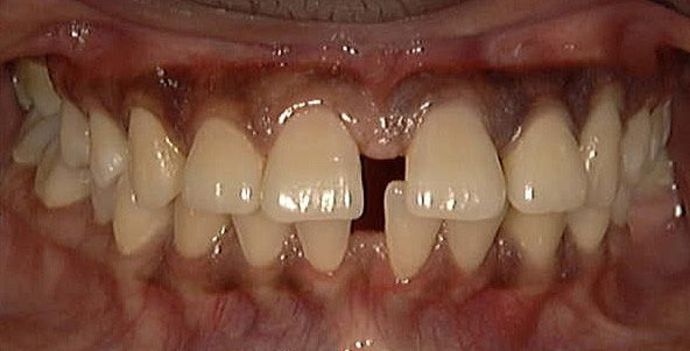 Veneers Case 6 - Before