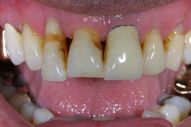 Veneers Case 8 - Before