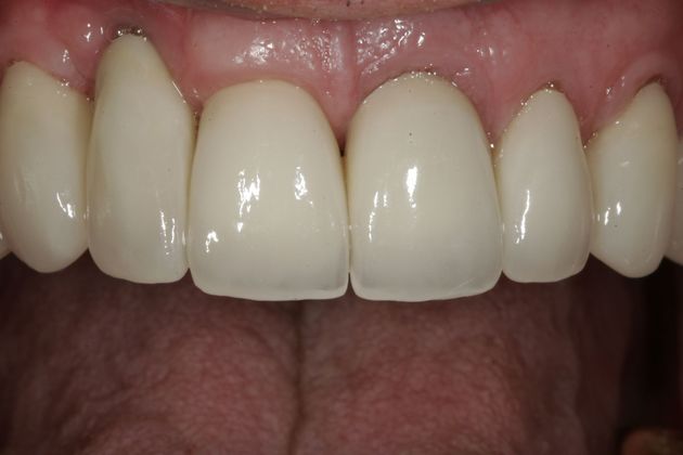 Veneers Case 8 - After