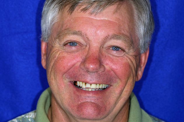 Veneers: Case 8 - Before