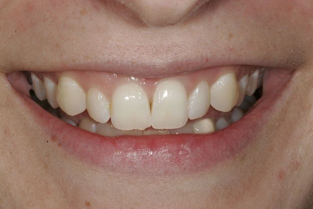 Veneers Case 9 - Before