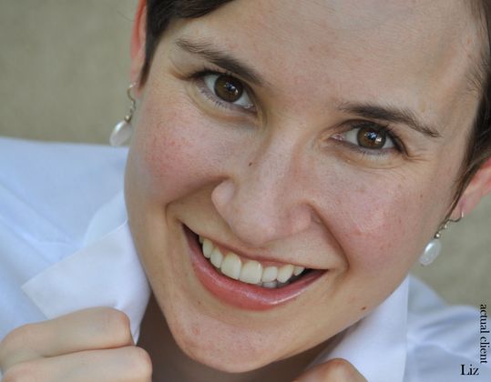 Veneers: Case 9 - After