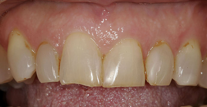 Veneers Case 10 - Before