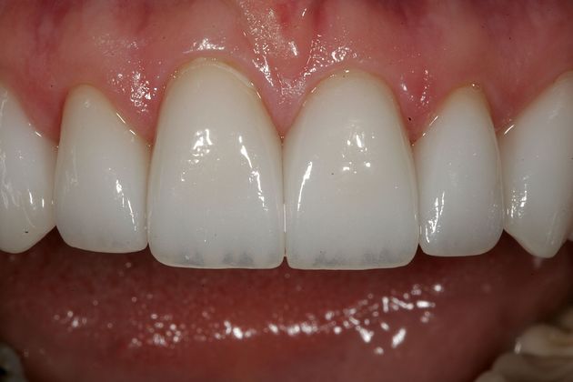 Veneers Case 11 - After