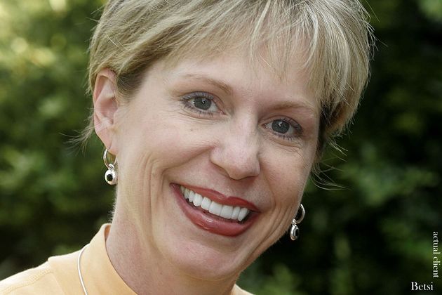 Veneers: Case 11 - After