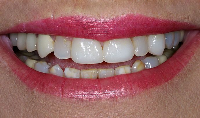 Veneers Case 12 - Before