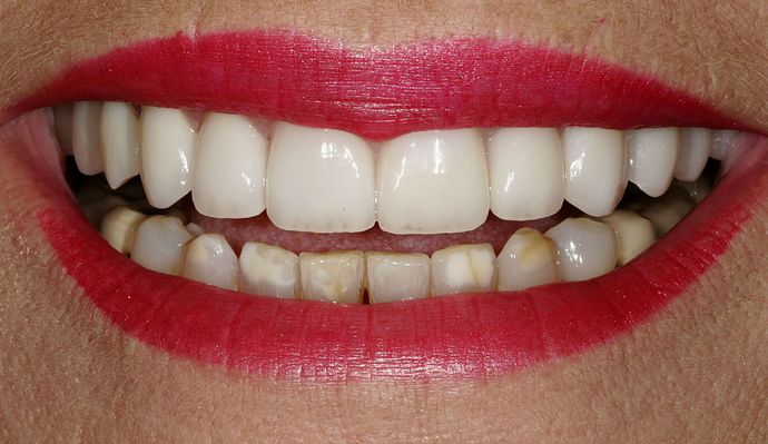 Veneers Case 12 - After