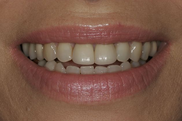 Veneers Case 13 - Before