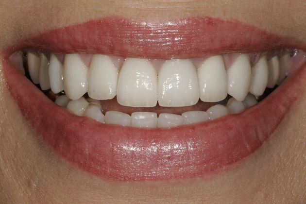 Veneers Case 13 - After