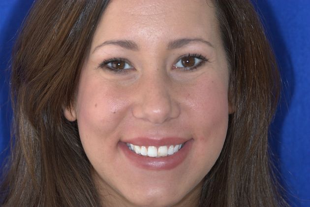 Veneers: Case 14 - Before