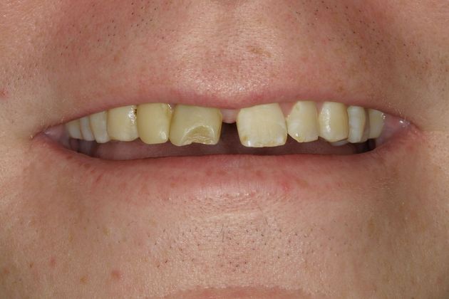 Veneers Case 15 - Before
