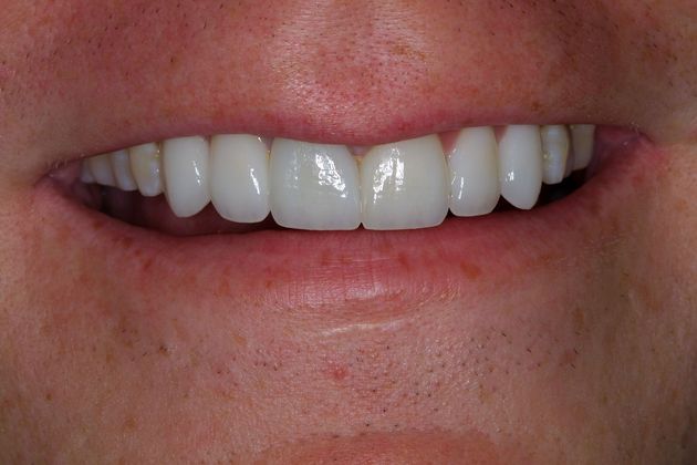 Veneers Case 15 - After