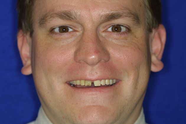 Veneers: Case 15 - Before