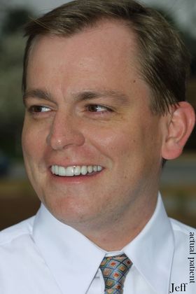 Veneers: Case 15 - After