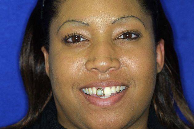 Veneers: Case 16 - Before