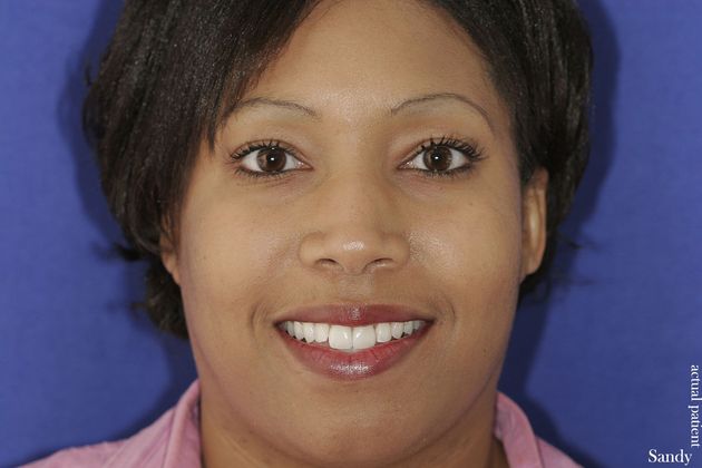 Veneers: Case 16 - After