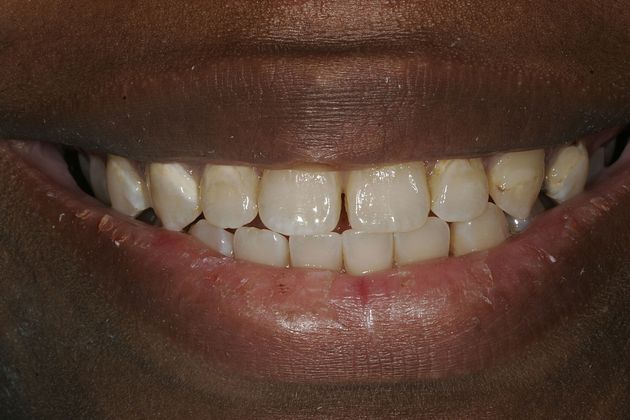 Veneers Case 17 - Before
