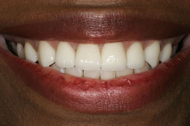 Veneers Case 17 - After