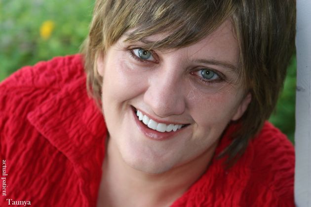 Veneers: Case 18 - After