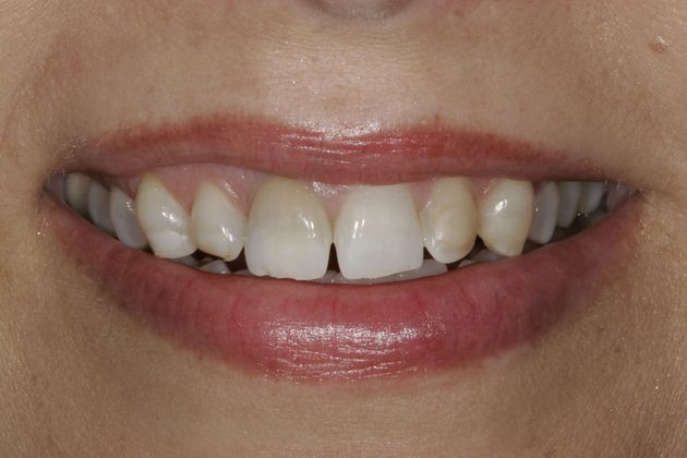 Veneers Case 19 - Before