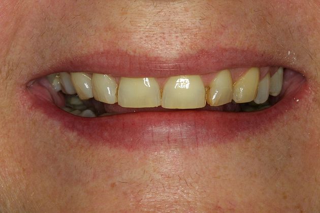 Veneers Case 20 - Before