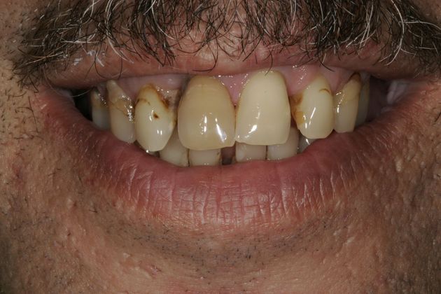 Veneers Case 22 - Before