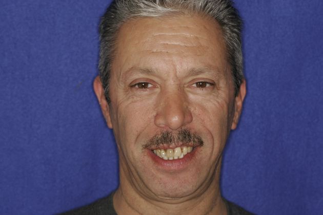 Veneers: Case 22 - Before