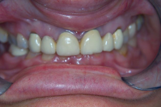 Porcelain Bridges Case 5 - Before