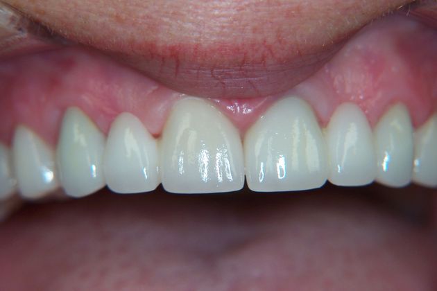 Porcelain Bridges Case 5 - After