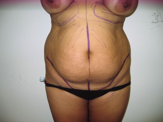 Abdominoplasty: Case 2 - before