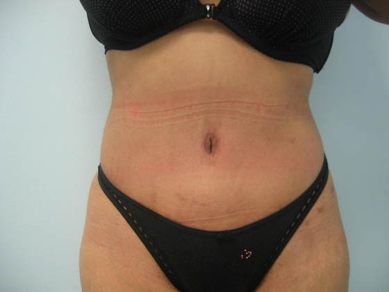 Abdominoplasty: Case 2 - After - Frontal view