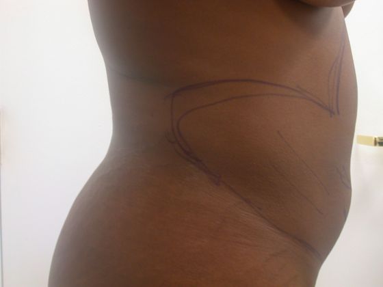 Liposuction: Case 1 - before