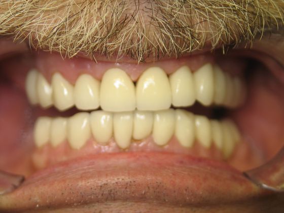 Smile Makeover: Monte