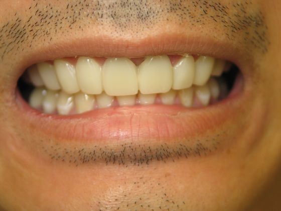 Snap On Smile: Patient #3 - Snap On Smile (After)