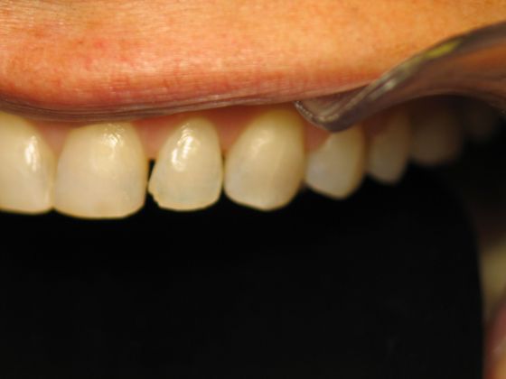 Smile Makeover: Patient #1 - Full Mouth Restoration (Before-Left)