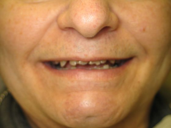 Porcelain Crowns: Patient # 2 - Dental Crowns (Before)
