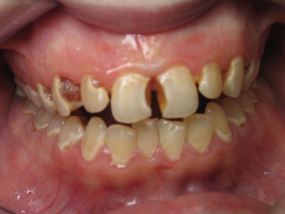Porcelain Crowns: Patient #1 - Dental Crowns (Before) 