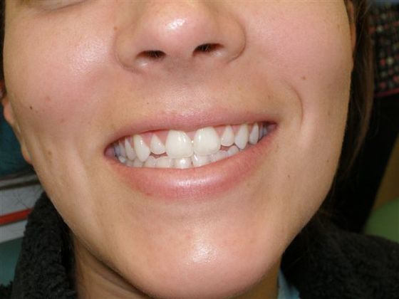 before veneers