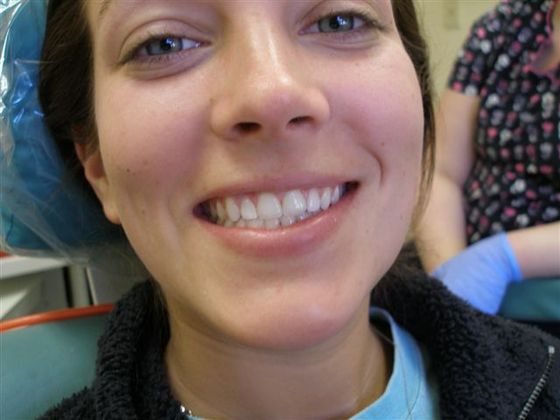 After veneers