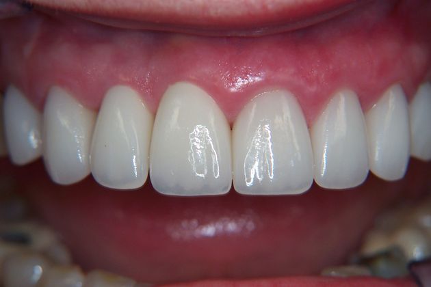 Porcelain Veneers: Case 12 - After