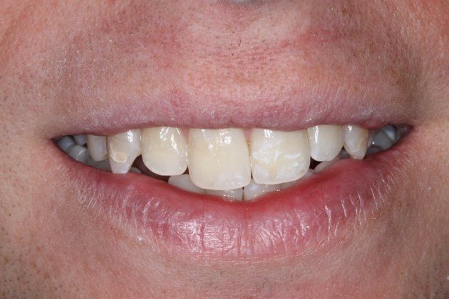 How To Get Rid Of White Spots On Teeth How To Get White Teeth Teeth 