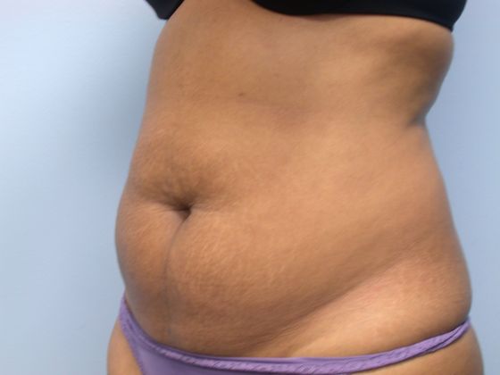 Abdominoplasty: Case 5 - before side view