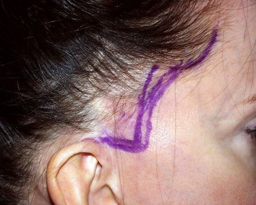 Hair Loss Surgery: Facelift Scar and Sideburn Repair - Preop Right Sideburn Repair
