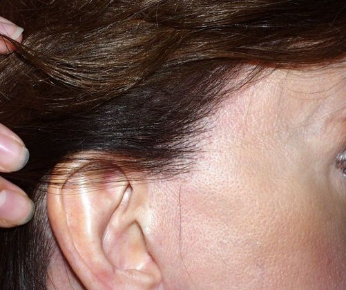 Hair Loss Surgery: Facelift Scar and Sideburn Repair - Postop Right Sideburn Repair