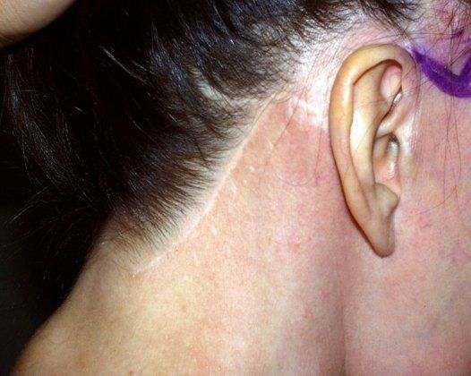 Facelift Scar And Sideburn Repair By Dr Konior Hair Loss Surgery