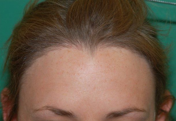 1688 Graft Female Hairline Restoration - Hair Loss Surgery 