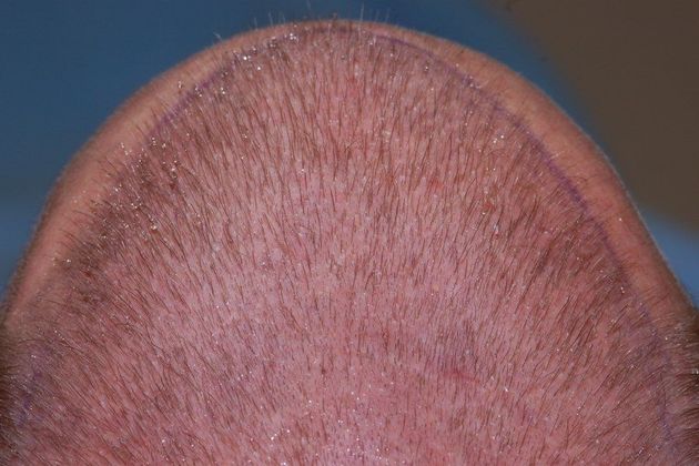 Hair Loss Surgery: 2810 Graft Frontal-Midscalp Restoration - Intraoperative Graft Placement
