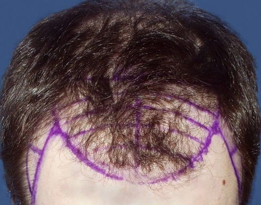 Hair Loss Surgery: 4086 Graft Staged Frontotemporal Restoration - Preop Front